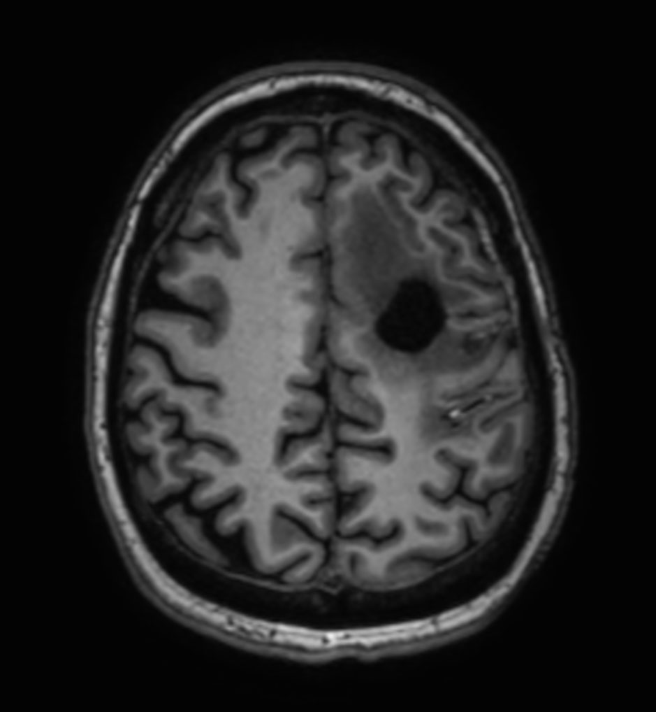 3D T1w TFE - Axial reformat