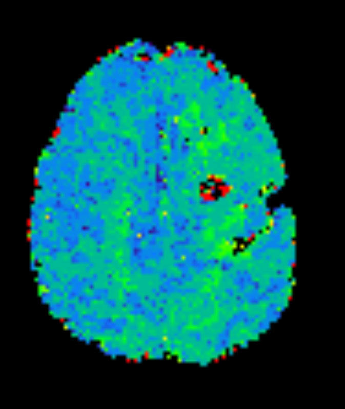 Axial T2* Perfusion - TO