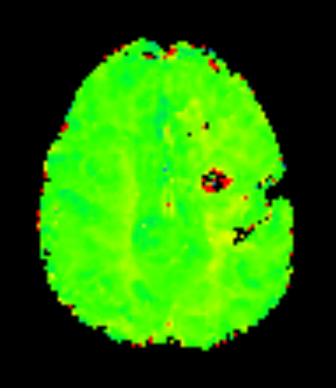 Axial T2* Perfusion - TTP