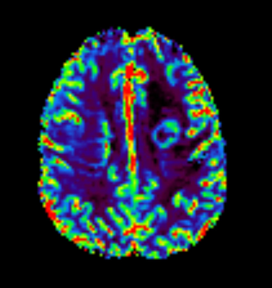 Axial T2* Perfusion - rCBF