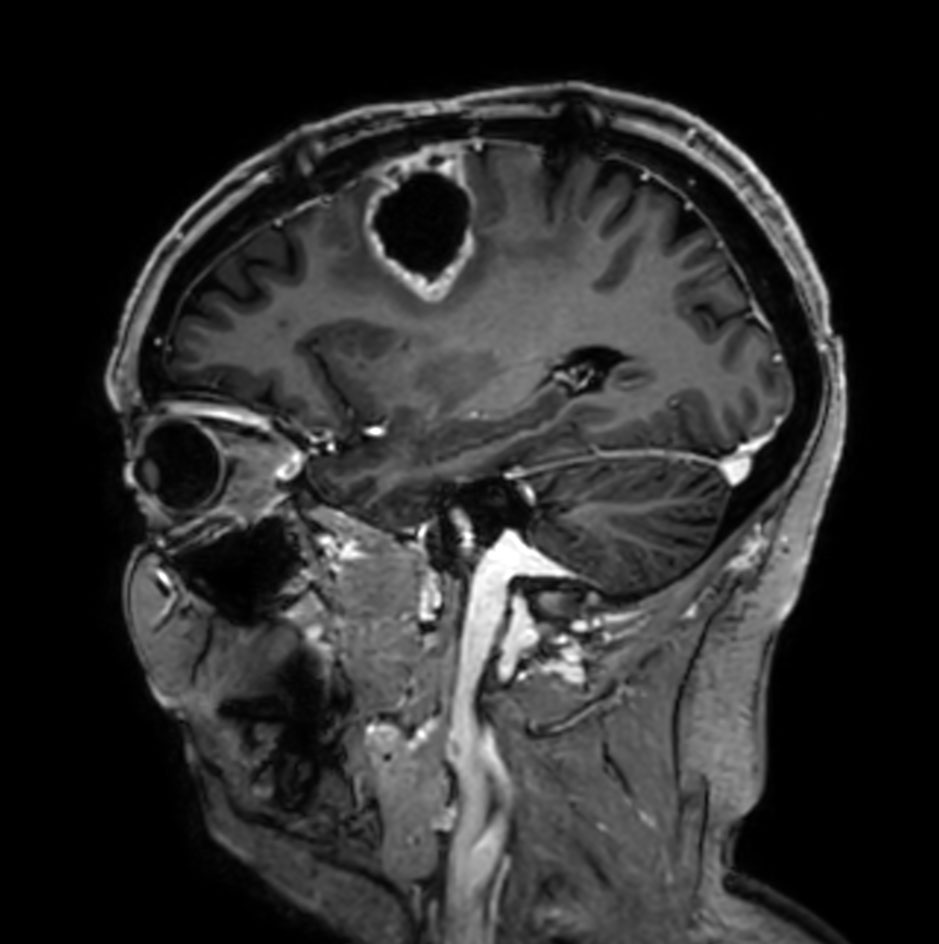 Sagittal 3D T1w TFE (with gado)