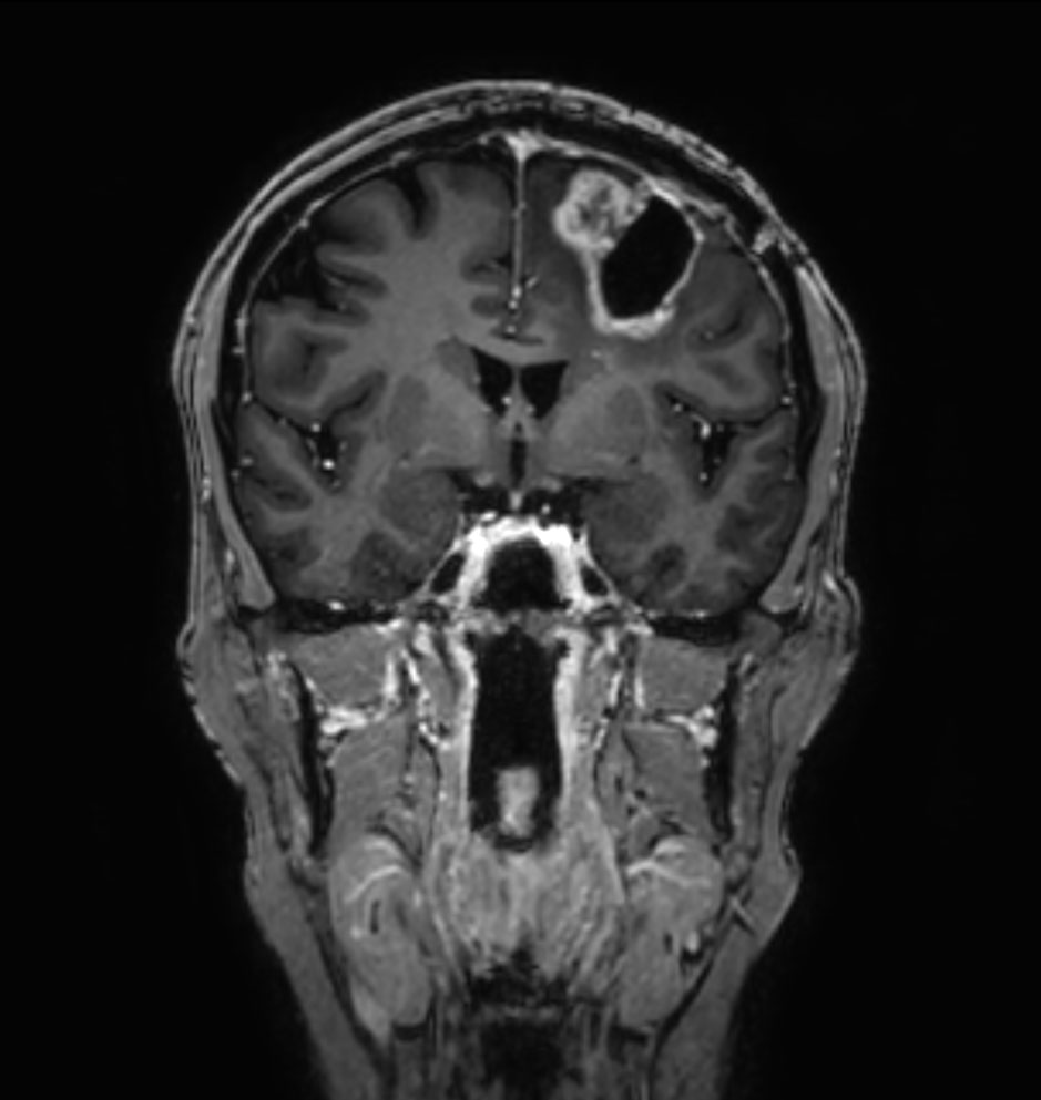3D T1w TFE - Coronal reformat (with gado)