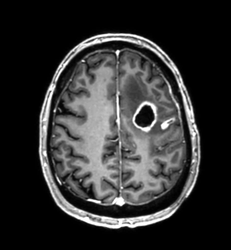 3D T1w TFE - Axial reformat (with gado)