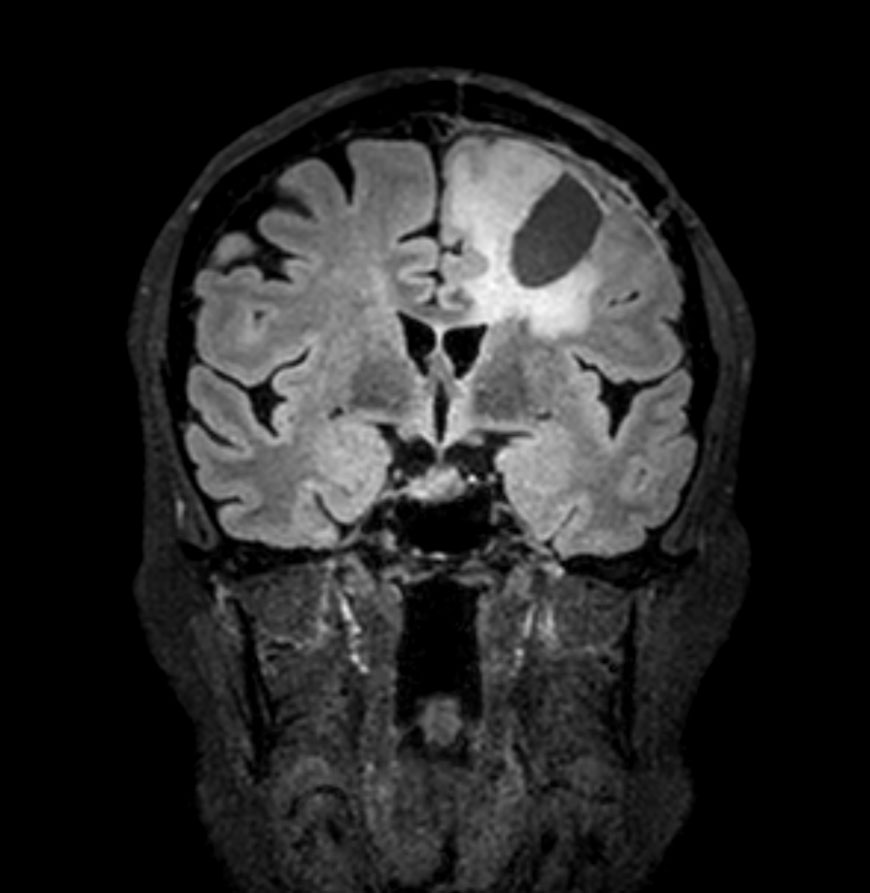 3D FLAIR - Coronal reformat