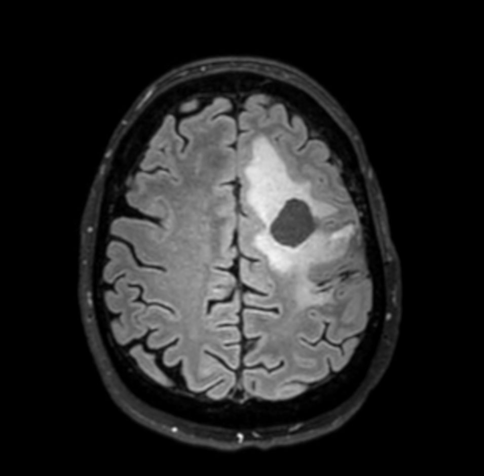 3D FLAIR - Axial reformat