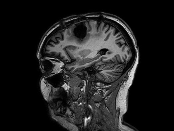 Sagittal 3D T1w TFE