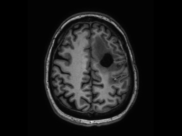 3D T1w TFE - Axial reformat