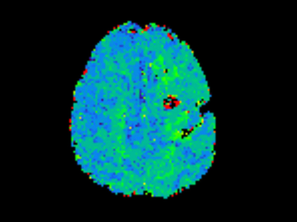 Axial T2* Perfusion - TO