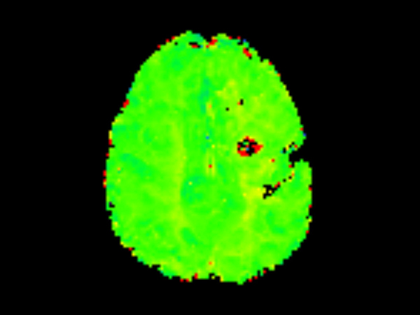 Axial T2* Perfusion - TTP