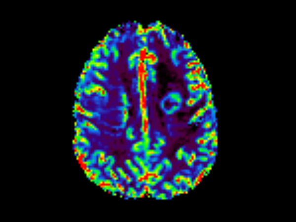 Axial T2* Perfusion - rCBF