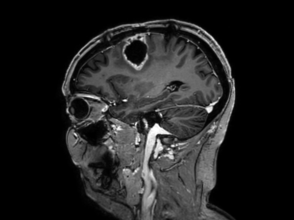 Sagittal 3D T1w TFE (with gado)