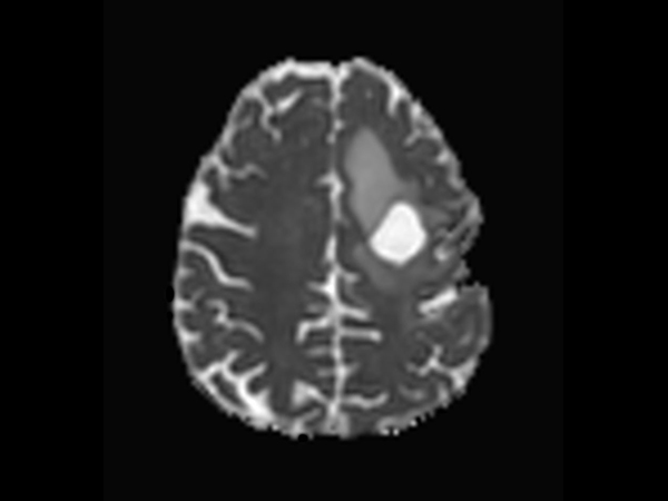 Axial DTI (ADC)