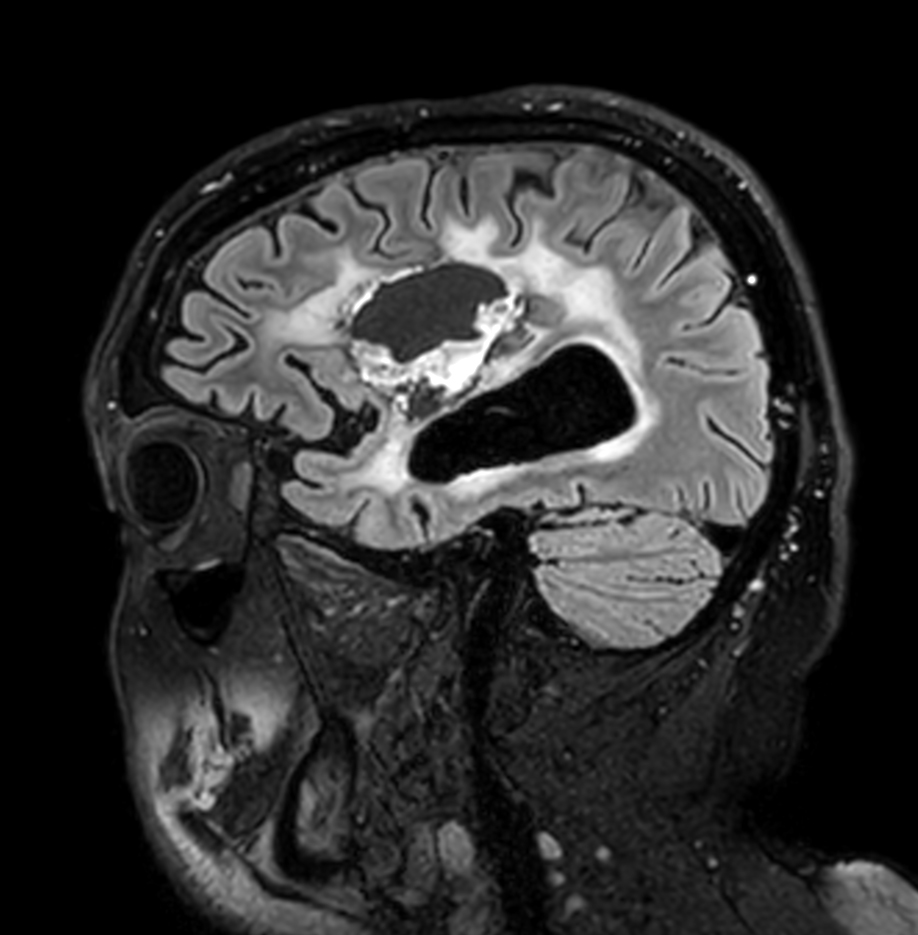 Sagittal 3D FLAIR
