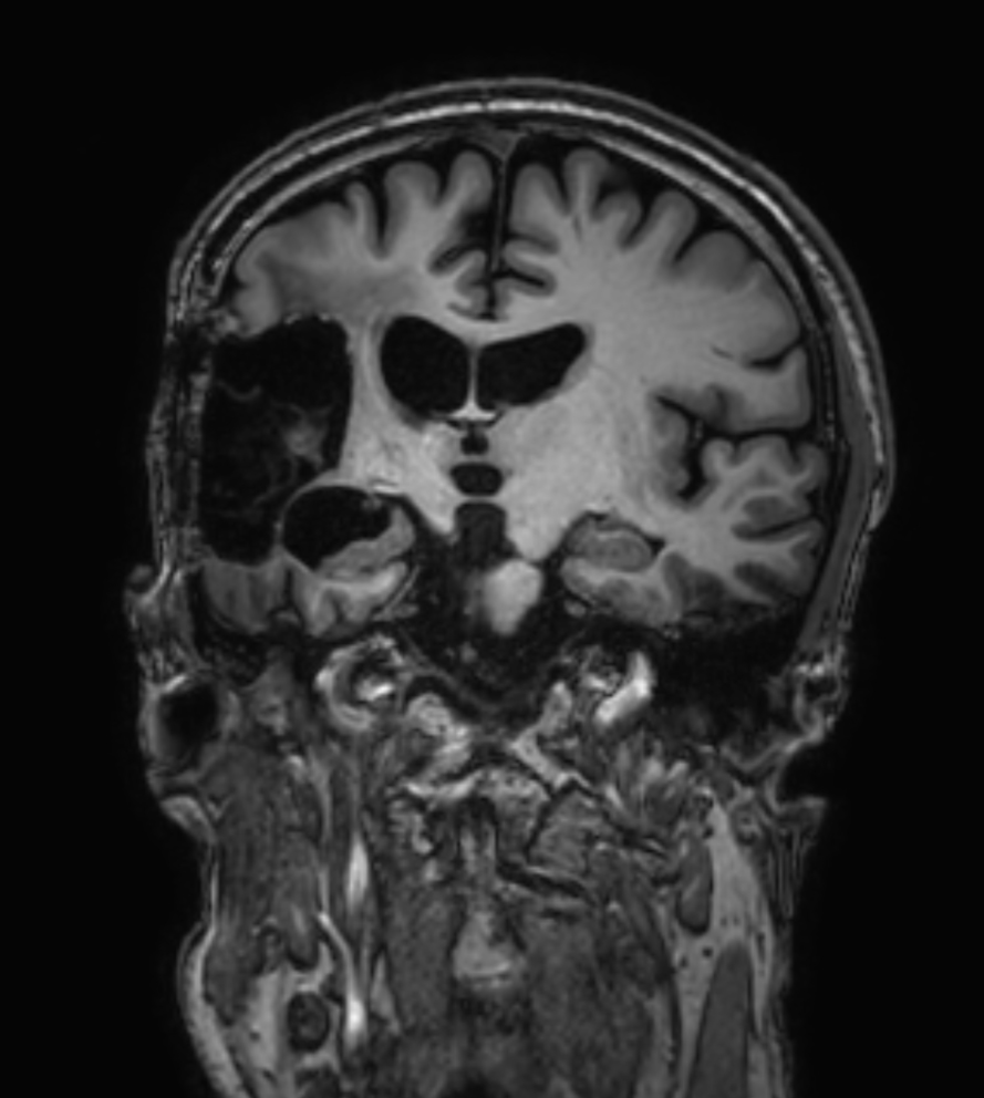 3D T1w TFE - Coronal reformat