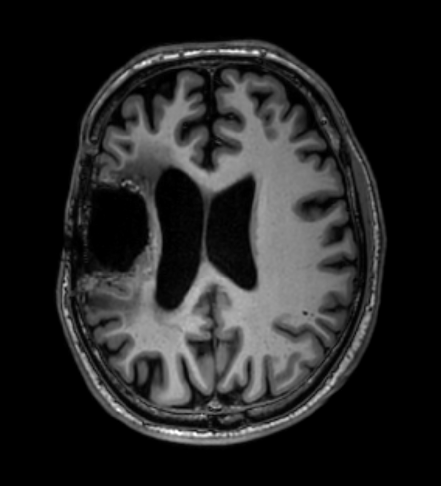 3D T1w TFE - Axial reformat