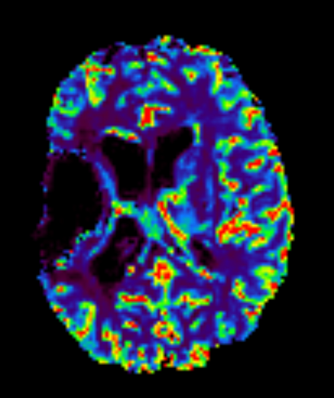 Axial T2* Perfusion - rCBF