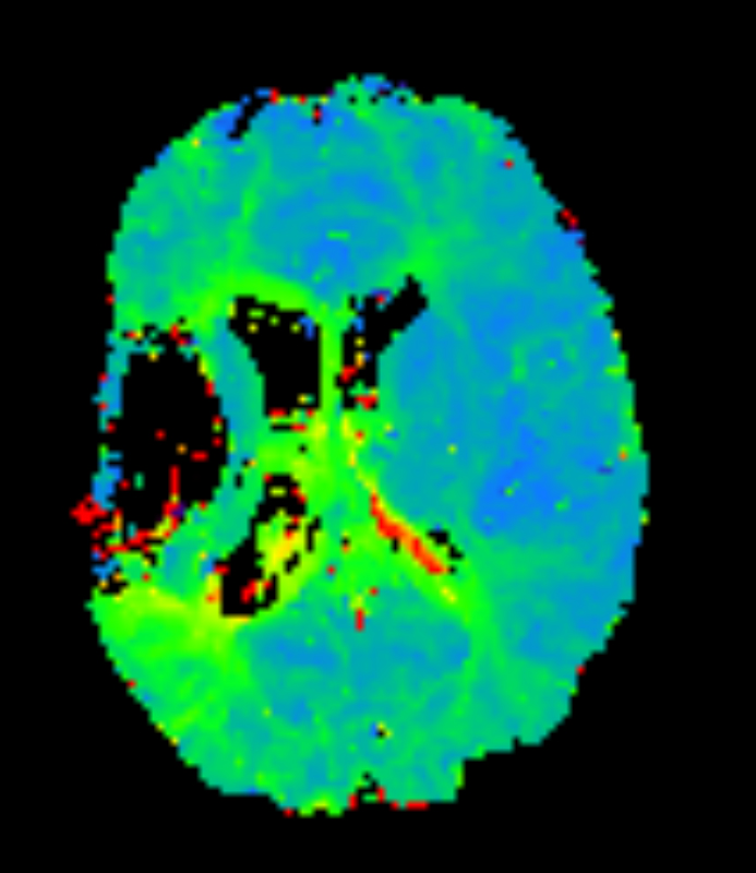 Axial T2* Perfusion - TTP