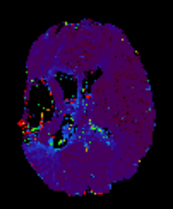 Axial T2* Perfusion - TO