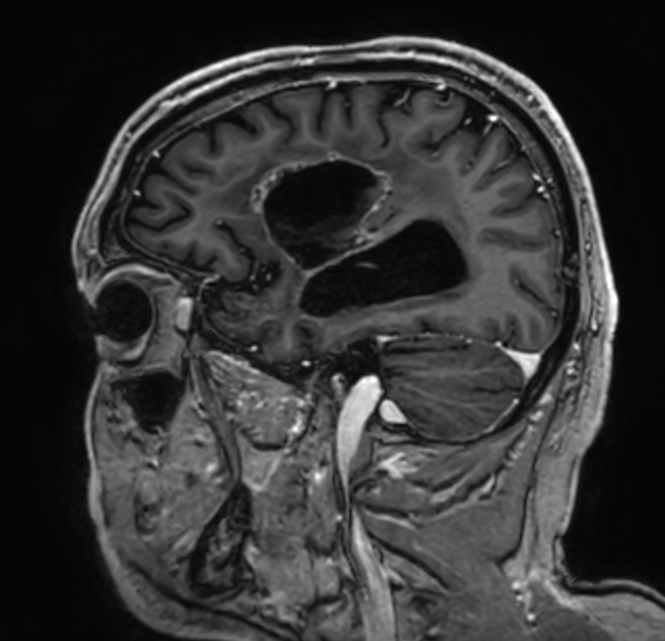 Sagittal 3D T1w TFE (with gado)