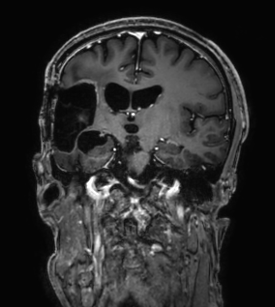 3D T1w TFE - Coronal reformat (with gado)