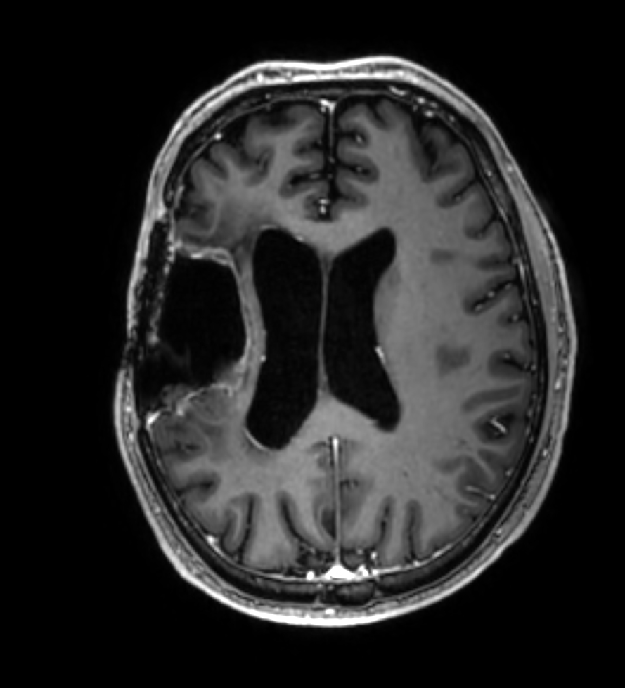 3D T1w TFE - Axial reformat (with gado)