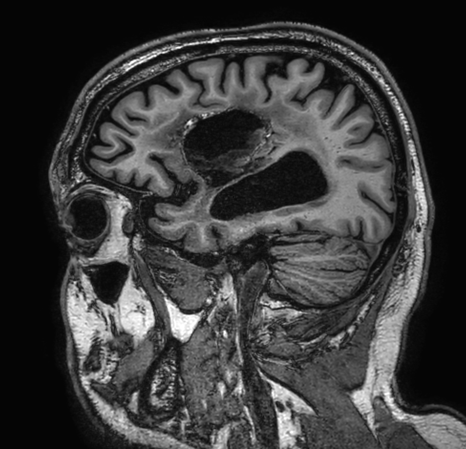 Sagittal 3D T1w TFE (high res, with gado)