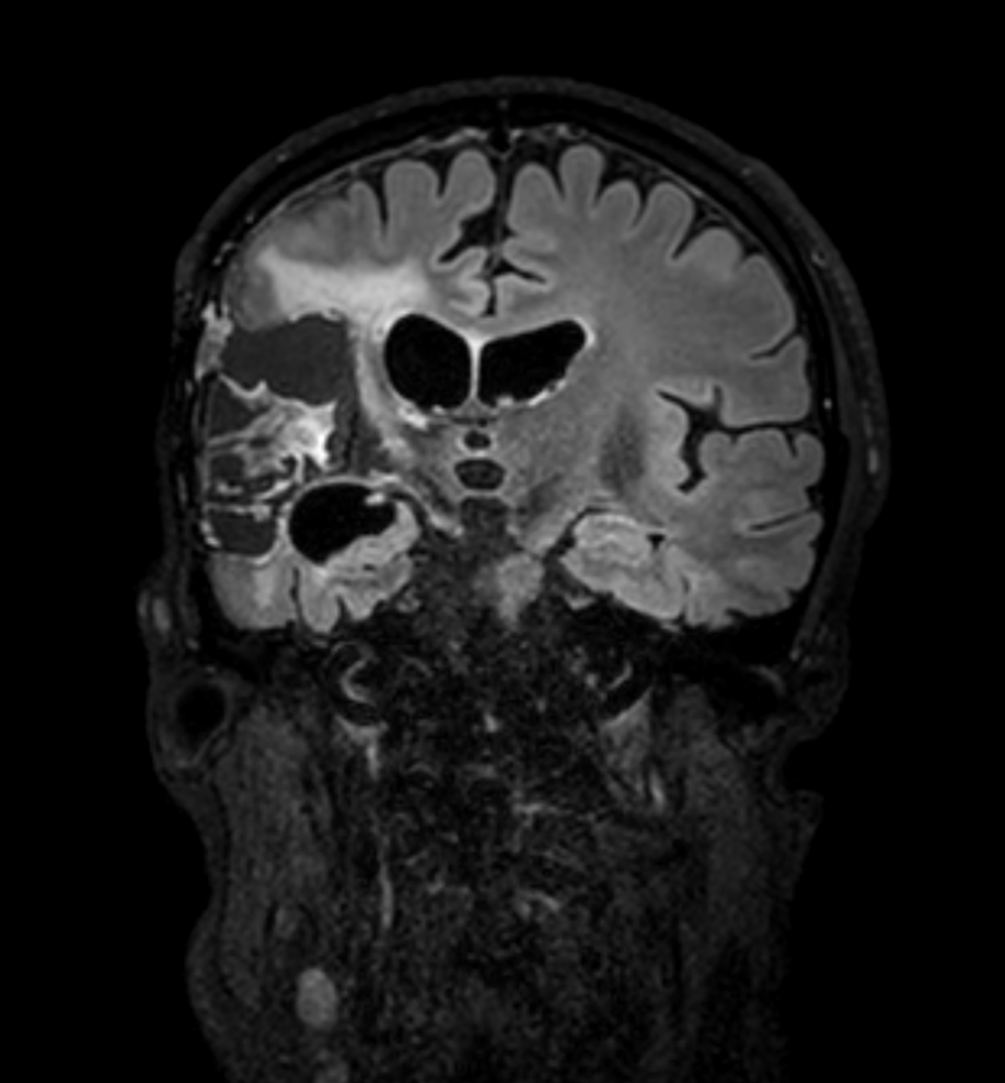 3D FLAIR - Coronal reformat