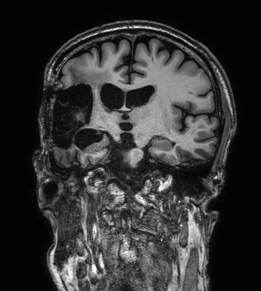 3D T1w TFE - Coronal reformat (high res, with gado)
