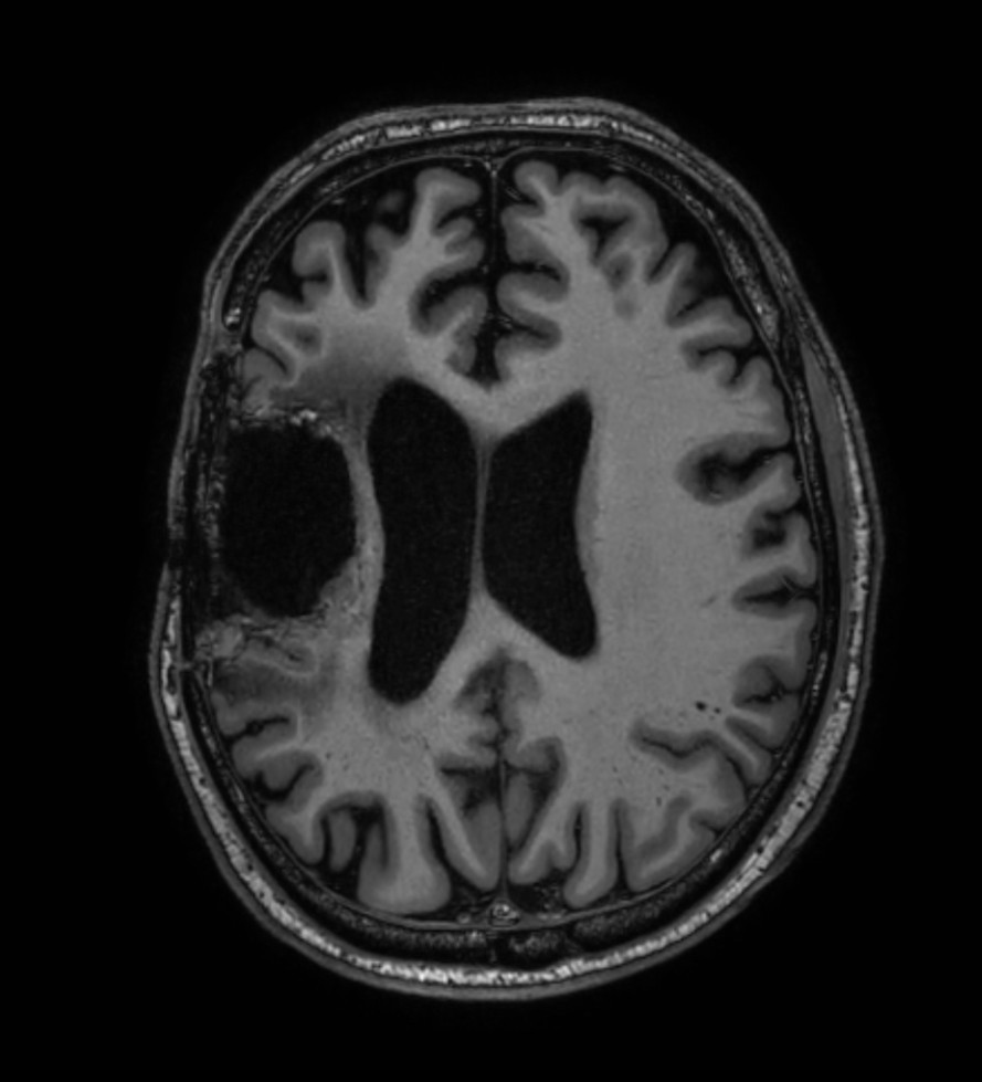 3D T1w TFE - Axial reformat (high res, with gado)