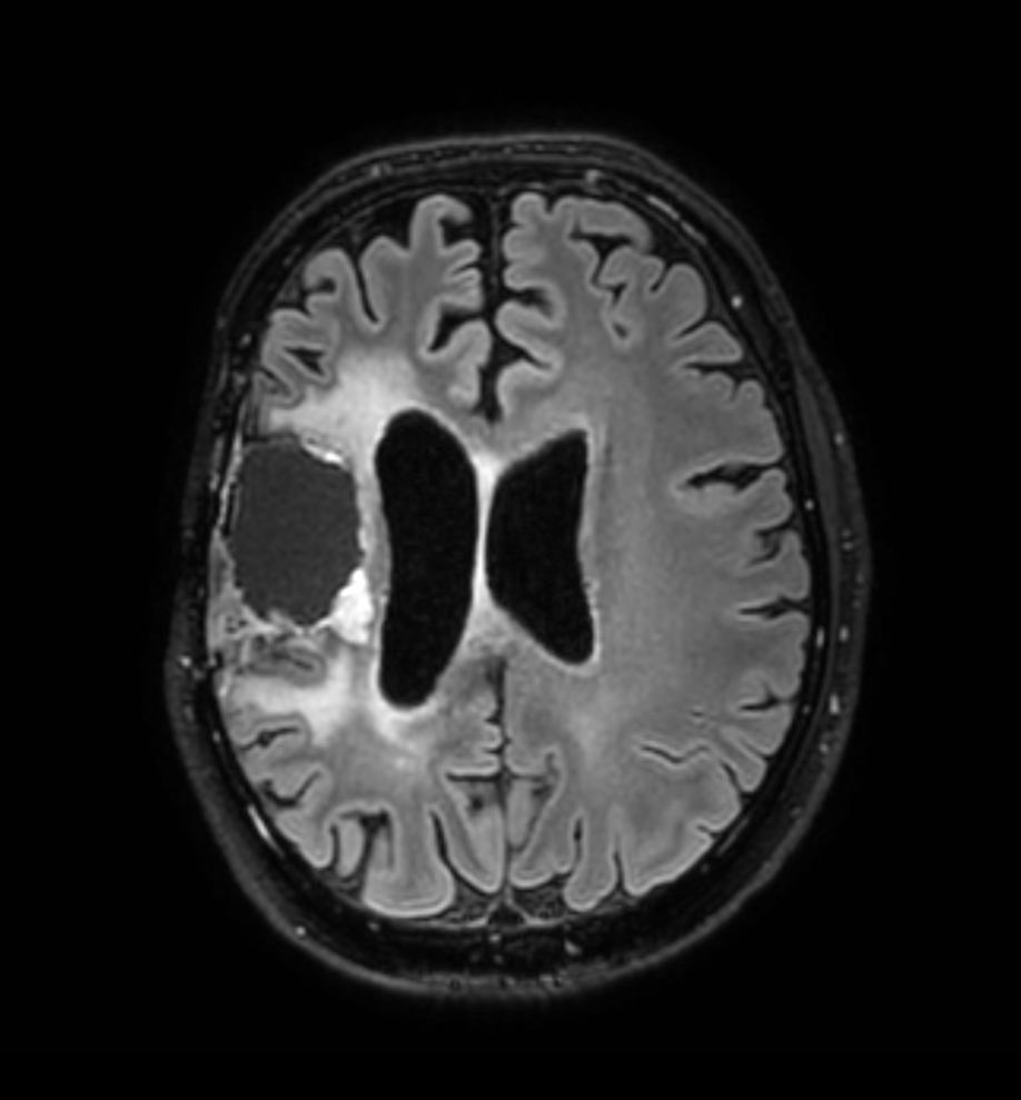 3D FLAIR - Axial reformat