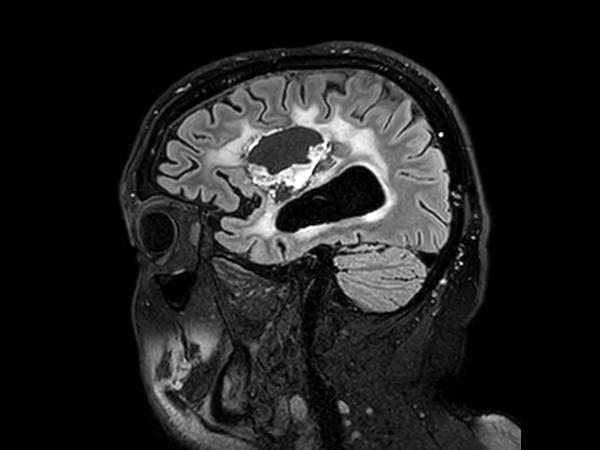 Sagittal 3D FLAIR