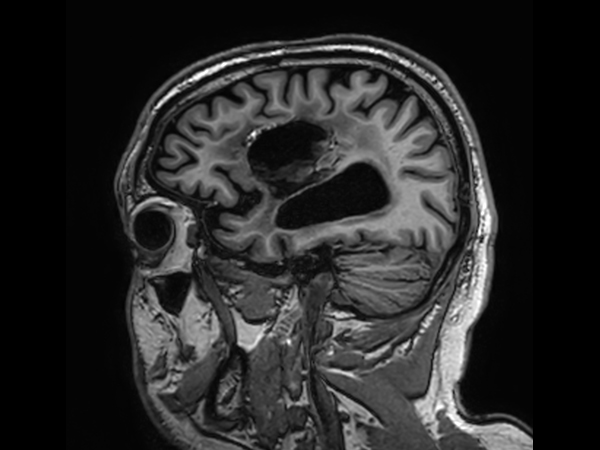 Sagittal 3D T1w TFE