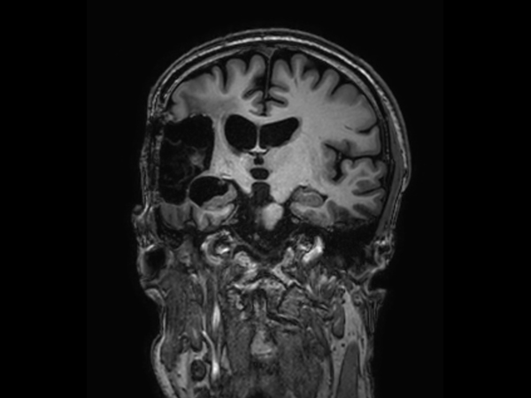 3D T1w TFE - Coronal reformat