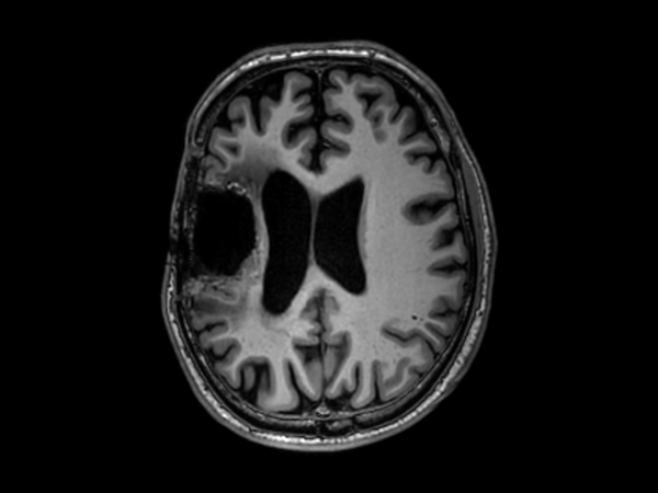 3D T1w TFE - Axial reformat