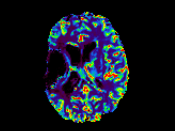 Axial T2* Perfusion - rCBF