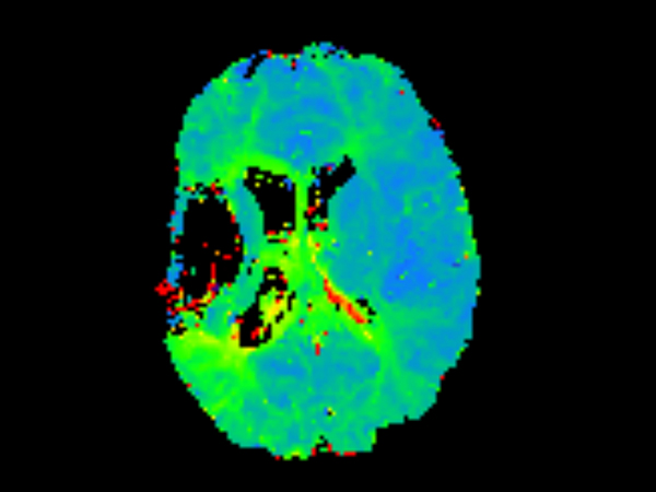 Axial T2* Perfusion - TTP