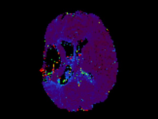 Axial T2* Perfusion - TO