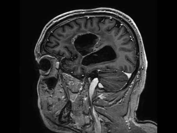 Sagittal 3D T1w TFE (with gado)