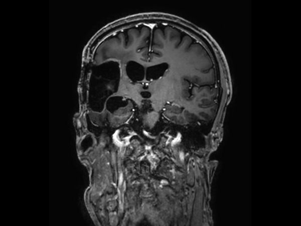 3D T1w TFE - Coronal reformat (with gado)