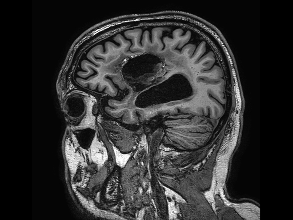 Sagittal 3D T1w TFE (high res, with gado)