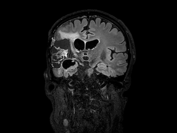 3D FLAIR - Coronal reformat