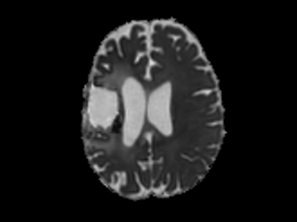 Axial DTI (ADC)