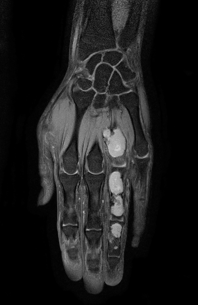 Coronal T1w mDIXON XD TSE (Water only)
