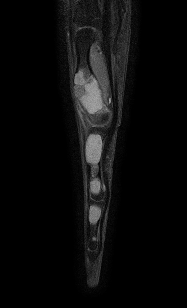 Sagittal T1w mDIXON XD TSE (Water only)