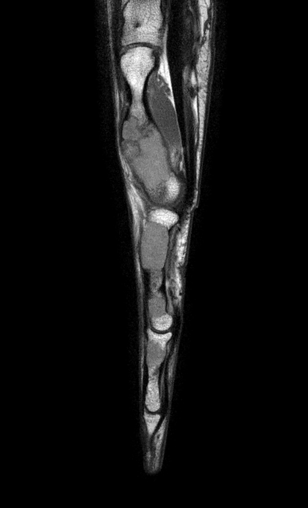 Sagittal T1w mDIXON XD TSE (In Phase)