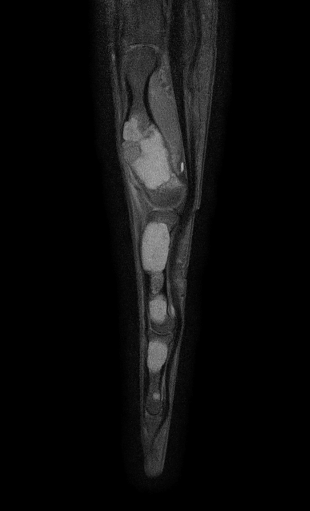 Sagittal T1w mDIXON XD TSE (Partial FatSat)