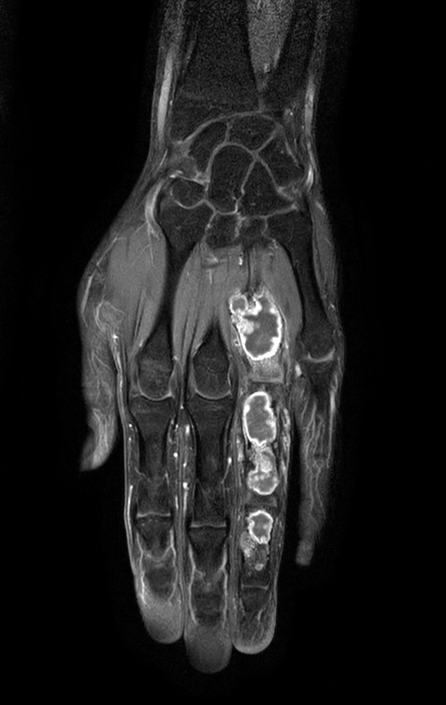 Coronal T1w mDIXON XD TSE (Water only) (with gado)