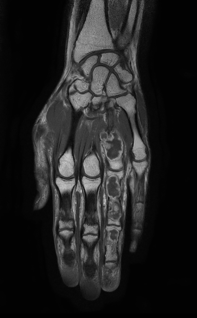 Coronal T1w mDIXON XD TSE (In Phase) (with gado)
