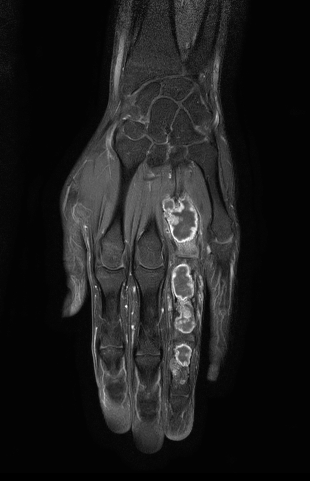 Coronal T1w mDIXON XD TSE (Partial FatSat) (with gado)