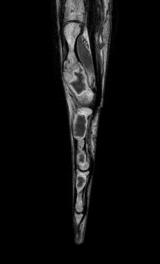 Sagittal T1w mDIXON XD TSE (In Phase) (with gado)